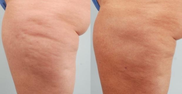 Eliminare la cellulite